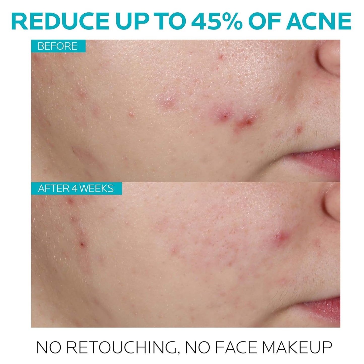 La Roche-Posay Effaclar Salicylic Acid Treatment to Minimize Pores, Clear Acne Blemishes and Post Acne Marks